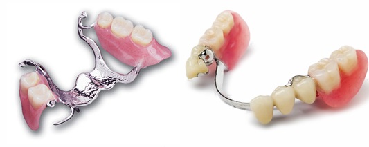 Цены на протезирование зубов бюгельными протезами