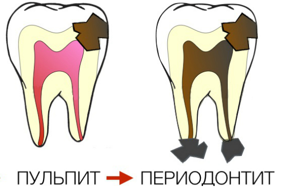удаление нерва зуба цена